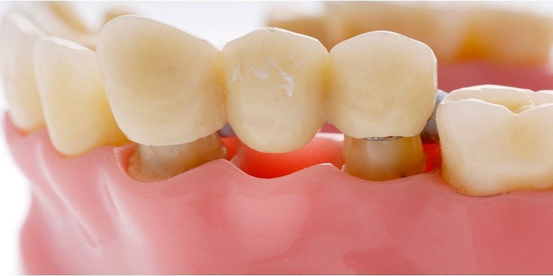 How Much Does A Dental Bridge Cost With Insurance