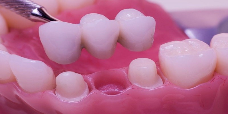 How Much Does A Dental Bridge Cost Without Insurance