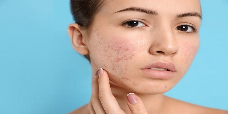 How Much Is Accutane With Insurance