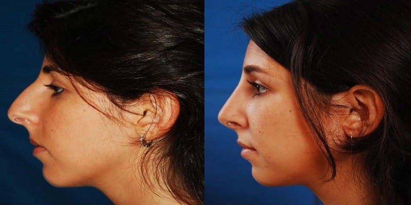 How To Get A Nose Job Covered By Insurance