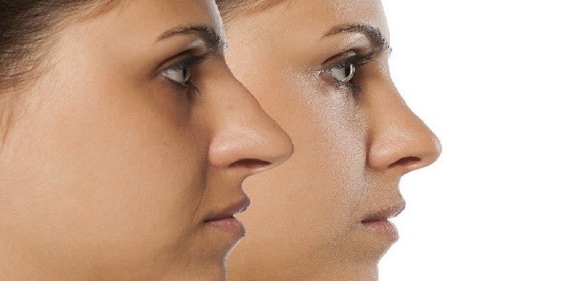 How To Get Rhinoplasty Covered By Insurance