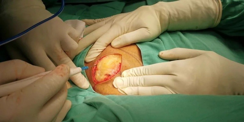 How To Get Lipoma Removal Covered By Insurance