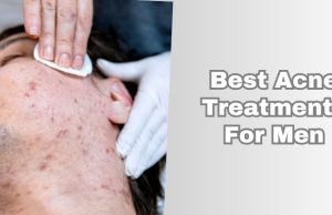best acne treatments for men