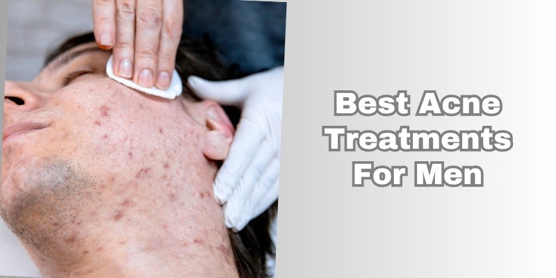 best acne treatments for men
