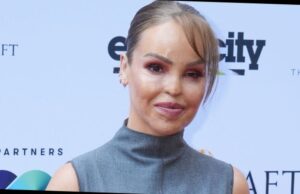 what happened to katie piper's face